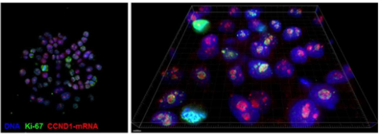 Fig.1. Breast cancer cell RNA detected using in situ hybridization.